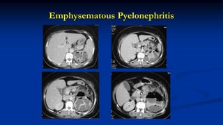Emphysematous Pyelonephritis
 
