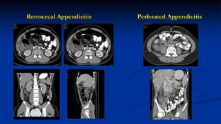 Retrocecal Appendicitis Perforated Appendicitis
 