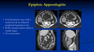 Epiploic Appendagitis
• Oval fat density mass with a
central dot & an inflamed
peripheral hyperdense rim
• D/D: omental infarct which is
usually larger
• Tt: conservative
 