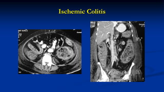 Ischemic Colitis
 
