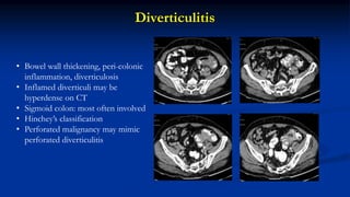Diverticulitis
• Bowel wall thickening, peri-colonic
inflammation, diverticulosis
• Inflamed diverticuli may be
hyperdense on CT
• Sigmoid colon: most often involved
• Hinchey’s classification
• Perforated malignancy may mimic
perforated diverticulitis
 