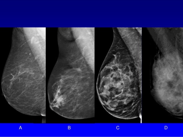 oslo study tomosynthesis Tomosynthesis and breast imaging update king’s study: oslo trial : comparison of digital mammography alone and. oslo study tomosynthesis Tomosynthesis and breast imaging update king’s study: oslo trial : comparison of digital mammography alone and.
