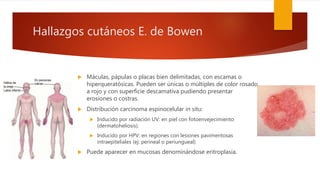 Hallazgos cutáneos E. de Bowen
 Máculas, pápulas o placas bien delimitadas, con escamas o
hiperqueratósicas. Pueden ser únicas o múltiples de color rosado
a rojo y con superficie descamativa pudiendo presentar
erosiones o costras.
 Distribución carcinoma espinocelular in situ:
 Inducido por radiación UV: en piel con fotoenvejecimiento
(dermatoheliosis).
 Inducido por HPV: en regiones con lesiones pavimentosas
intraepiteliales (ej: perineal o periungueal)
 Puede aparecer en mucosas denominándose eritroplasia.
 