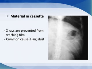 • Material in cassette
- X rays are prevented from
reaching film
- Common cause: Hair; dust
 