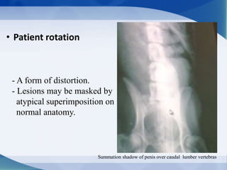 • Patient rotation
- A form of distortion.
- Lesions may be masked by
atypical superimposition on
normal anatomy.
Summation shadow of penis over caudal lumber vertebras
 