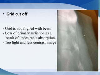 • Grid cut off
- Grid is not aligned with beam
- Loss of primary radiation as a
result of undesirable absorption.
- Too light and less contrast image
 