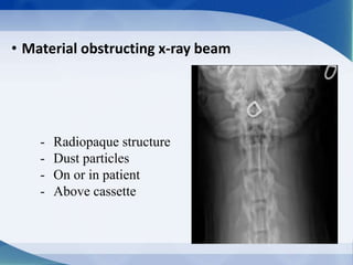 • Material obstructing x-ray beam
- Radiopaque structure
- Dust particles
- On or in patient
- Above cassette
 