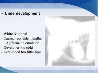 • Underdevelopment
- White & global
- Cause: Too little metallic
Ag forms in emulsion
- Developer too cold
- Developed too little time
 