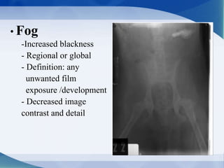 • Fog
-Increased blackness
- Regional or global
- Definition: any
unwanted film
exposure /development
- Decreased image
contrast and detail
 