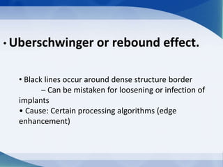 • Uberschwinger or rebound effect.
• Black lines occur around dense structure border
– Can be mistaken for loosening or infection of
implants
• Cause: Certain processing algorithms (edge
enhancement)
 