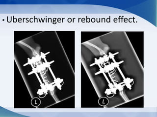 • Uberschwinger or rebound effect.
 