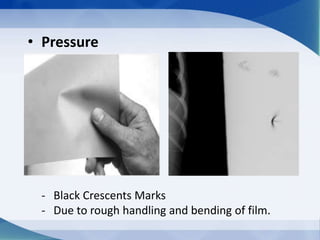 • Pressure
- Black Crescents Marks
- Due to rough handling and bending of film.
 