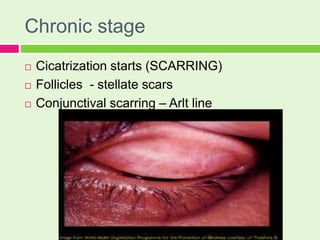 Dr.A.R.Rajalakshmi, 8.2.17 chronic conjunctivitis ii | PPTX