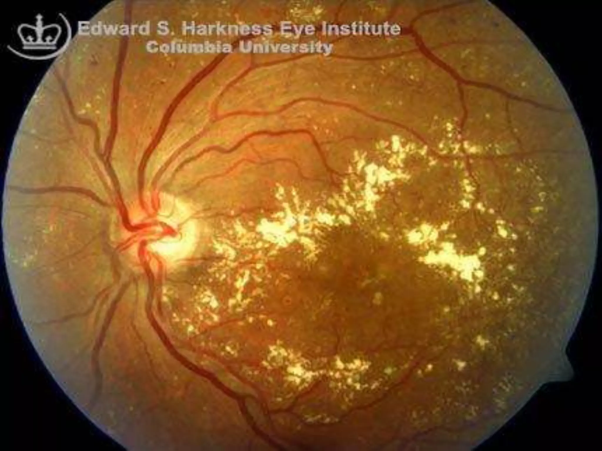 Diabetic Retinopathy (Molecular mechanisms,types,fundoscopy,diagnosis ...