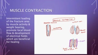 MUSCLE CONTRACTION
Intermittent loading
of the fracture area
by muscle activity &
weight bearing,
promote local blood
flow & development
of electrical fields
which are beneficial
for healing
 