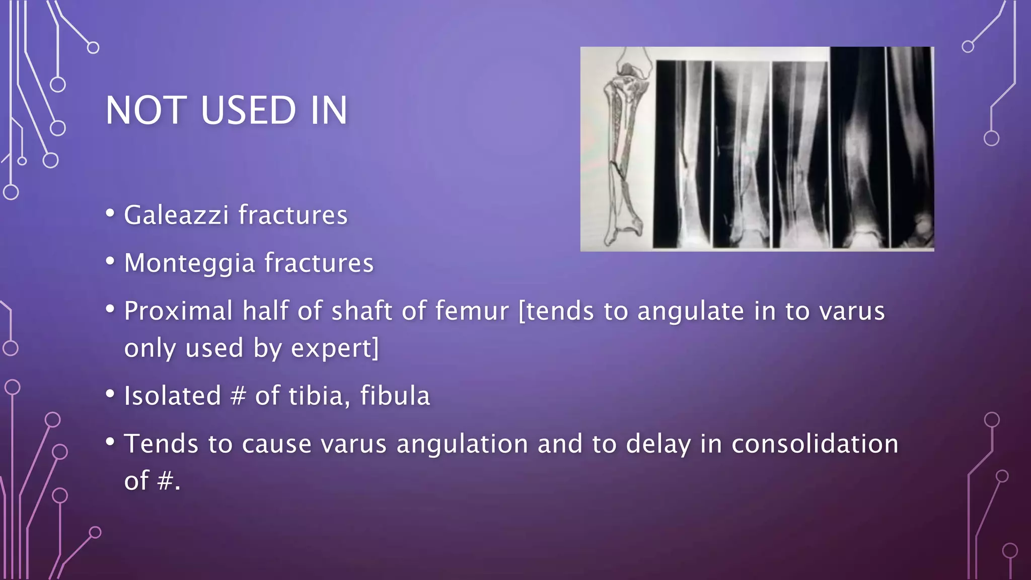 NOT USED IN
• Galeazzi fractures
• Monteggia fractures
• Proximal half of shaft of femur [tends to angulate in to varus
only used by expert]
• Isolated # of tibia, fibula
• Tends to cause varus angulation and to delay in consolidation
of #.
 