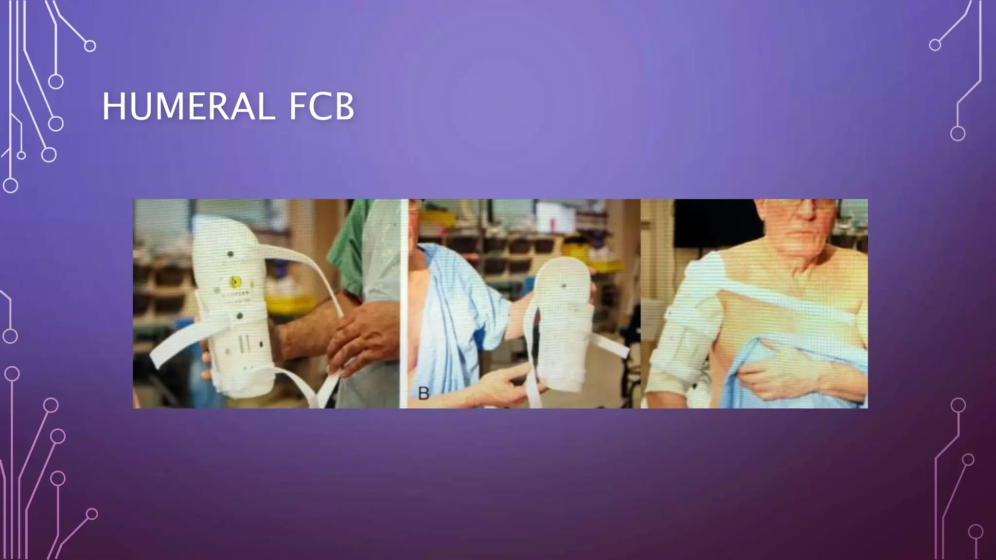 HUMERAL FCB
 