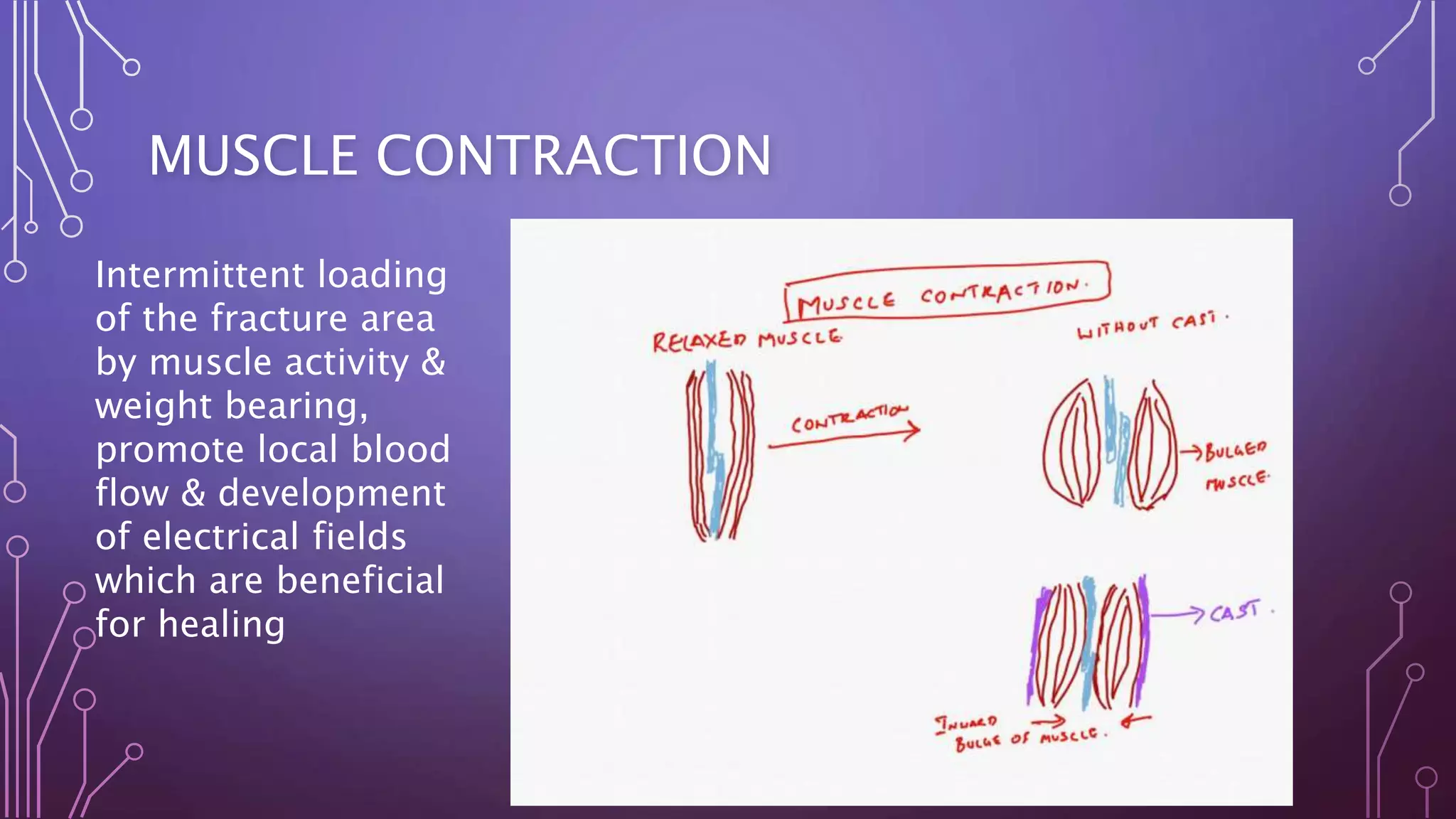 MUSCLE CONTRACTION
Intermittent loading
of the fracture area
by muscle activity &
weight bearing,
promote local blood
flow & development
of electrical fields
which are beneficial
for healing
 