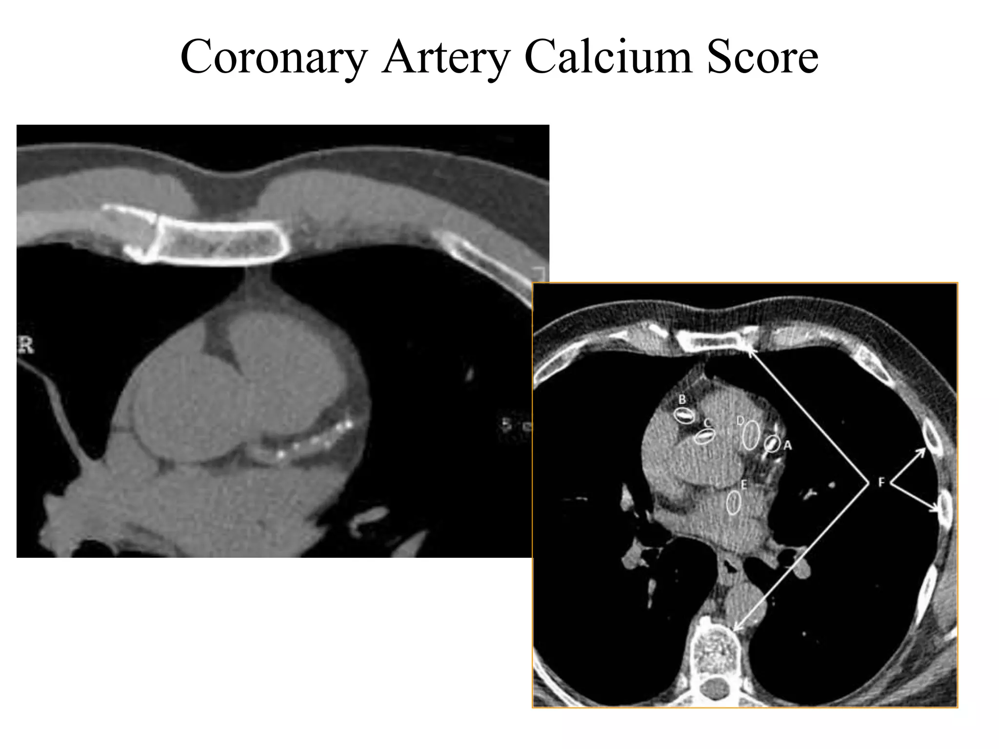 Coronary Artery Calcium Score
32
 