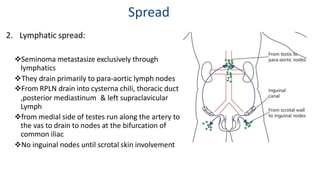 Testicular Tumors