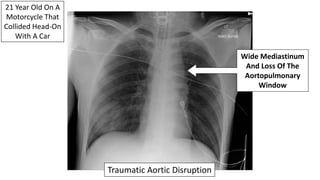 21 Year Old On A
Motorcycle That
Collided Head-On
With A Car
Wide Mediastinum
And Loss Of The
Aortopulmonary
Window
Traumatic Aortic Disruption
 