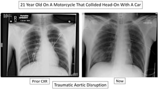 21 Year Old On A Motorcycle That Collided Head-On With A Car
Prior CXR Now
Traumatic Aortic Disruption
 