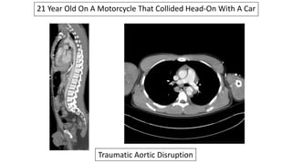 21 Year Old On A Motorcycle That Collided Head-On With A Car
Traumatic Aortic Disruption
 