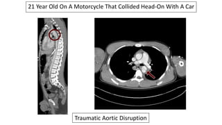 21 Year Old On A Motorcycle That Collided Head-On With A Car
Traumatic Aortic Disruption
 