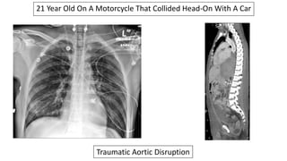 21 Year Old On A Motorcycle That Collided Head-On With A Car
Traumatic Aortic Disruption
 