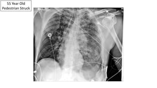 55 Year Old
Pedestrian Struck
 