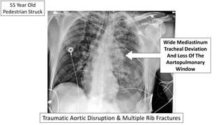 55 Year Old
Pedestrian Struck
Wide Mediastinum
Tracheal Deviation
And Loss Of The
Aortopulmonary
Window
Traumatic Aortic Disruption & Multiple Rib Fractures
 