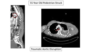 55 Year Old Pedestrian Struck
Traumatic Aortic Disruption
 