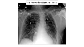 55 Year Old Pedestrian Struck
 