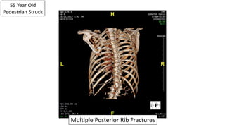 55 Year Old
Pedestrian Struck
Multiple Posterior Rib Fractures
 