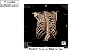 55 Year Old
Pedestrian Struck
Multiple Posterior Rib Fractures
*
*
*
*
*
*
*
 