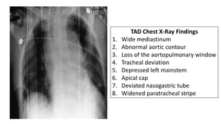 TAD Chest X-Ray Findings
1. Wide mediastinum
2. Abnormal aortic contour
3. Loss of the aortopulmonary window
4. Tracheal deviation
5. Depressed left mainstem
6. Apical cap
7. Deviated nasogastric tube
8. Widened paratracheal stripe
 
