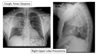 Right Upper Lobe Pneumonia
Cough, Fever, Dyspnea
 