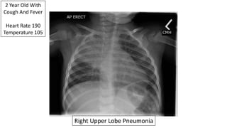 2 Year Old With
Cough And Fever
Heart Rate 190
Temperature 105
Right Upper Lobe Pneumonia
 