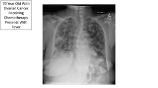70 Year Old With
Ovarian Cancer
Receiving
Chemotherapy
Presents With
Fever
 