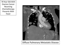 70 Year Old With
Ovarian Cancer
Receiving
Chemotherapy
Presents With
Fever
Diffuse Pulmonary Metastatic Disease
 