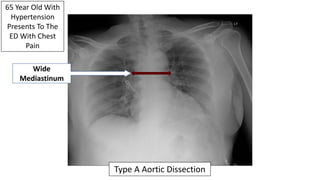 65 Year Old With
Hypertension
Presents To The
ED With Chest
Pain
Wide
Mediastinum
Type A Aortic Dissection
 