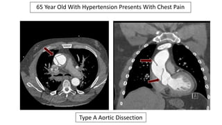 65 Year Old With Hypertension Presents With Chest Pain
Type A Aortic Dissection
 