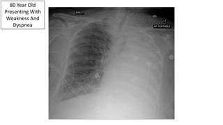 80 Year Old
Presenting With
Weakness And
Dyspnea
 
