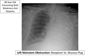 80 Year Old
Presenting With
Weakness And
Dyspnea
Left Mainstem Obstruction: Neoplasm Vs. Mucous Plug
 