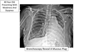 80 Year Old
Presenting With
Weakness And
Dyspnea
Bronchoscopy Reveal A Mucous Plug
 