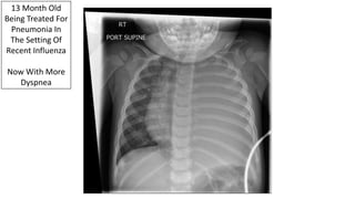 13 Month Old
Being Treated For
Pneumonia In
The Setting Of
Recent Influenza
Now With More
Dyspnea
 