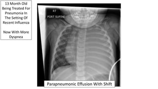 13 Month Old
Being Treated For
Pneumonia In
The Setting Of
Recent Influenza
Now With More
Dyspnea
Parapneumonic Effusion With Shift
 