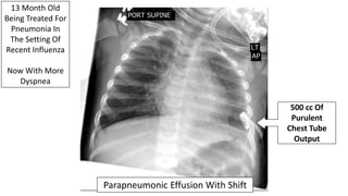 Parapneumonic Effusion With Shift
500 cc Of
Purulent
Chest Tube
Output
13 Month Old
Being Treated For
Pneumonia In
The Setting Of
Recent Influenza
Now With More
Dyspnea
 