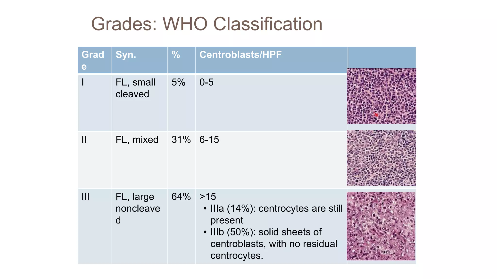 Follicular Lymphoma PPTX