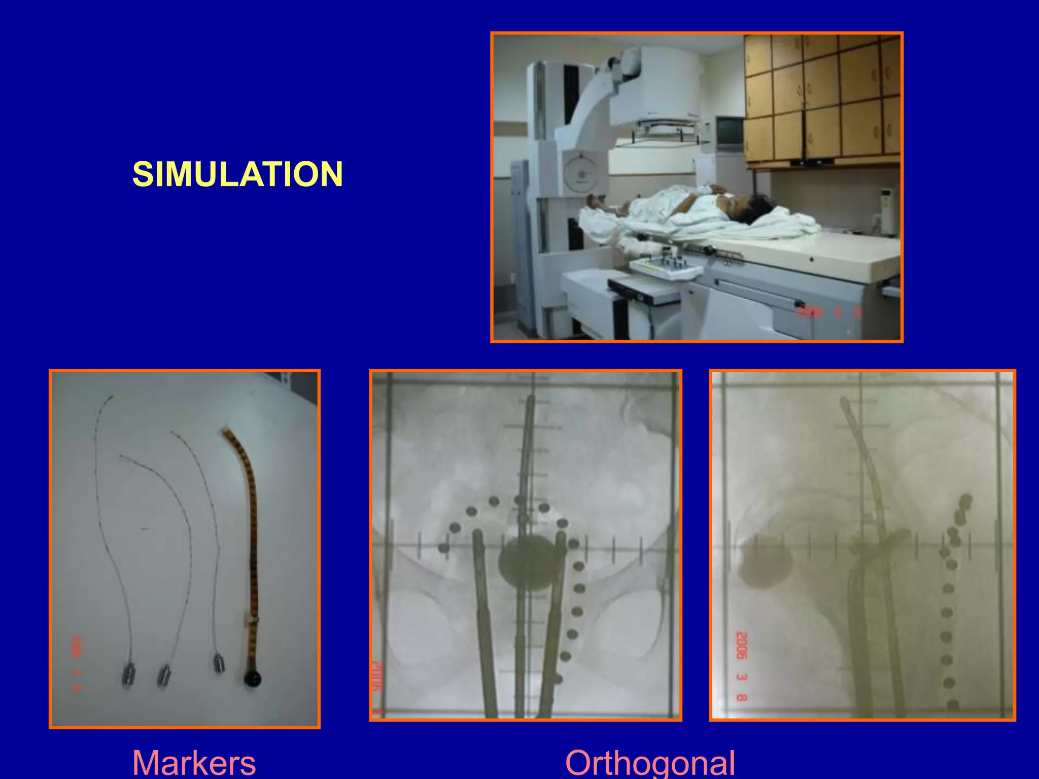 SIMULATION
Markers
Markers Orthogonal
 